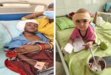 राष्ट्रीय बाल स्वास्थ्य कार्यक्रम (चिरायु) का असर: जन्मजात बधिरता से जूझ रहे तीन बच्चों का एम्स रायपुर में सफल कॉक्लियर इंप्लांट