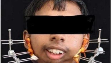 जटिल सर्जरी से खुला मुंह, आयुष्मान योजना से मिला निःशुल्क उपचार