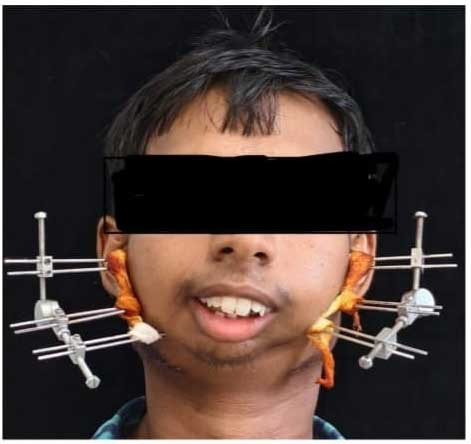 जटिल सर्जरी से खुला मुंह, आयुष्मान योजना से मिला निःशुल्क उपचार जटिल सर्जरी से खुला मुंह, आयुष्मान योजना से मिला निःशुल्क उपचार
