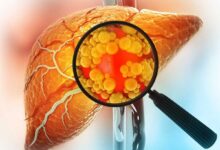 Fatty Liver: 5 Vegetables That May Support Liver Health